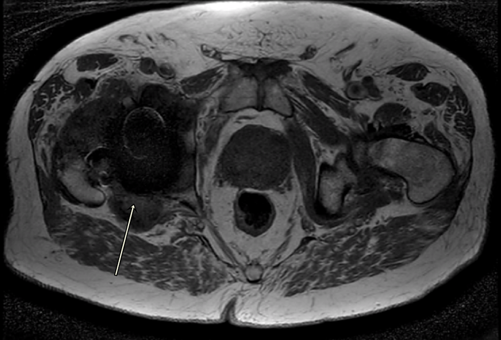 Cureus A Case Report and Literature Review to Aid in the Management