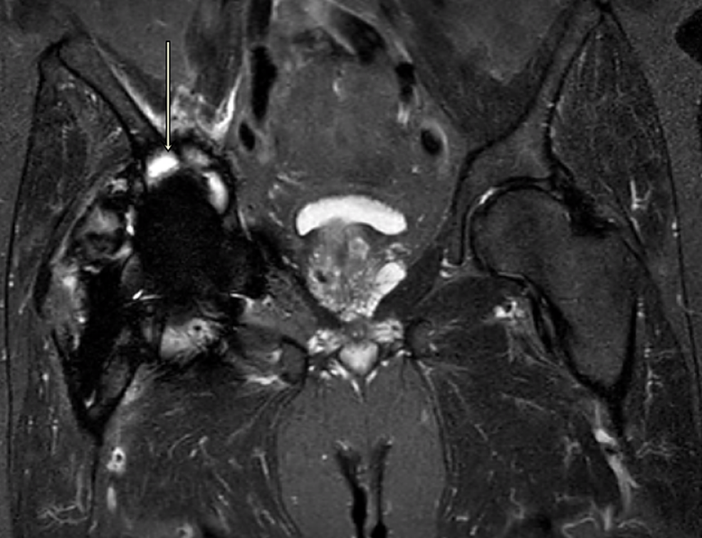 A Case Report and Literature Review to Aid in the Management of