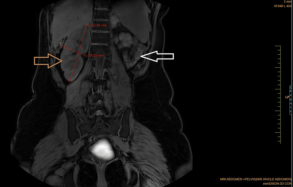 Wunderlich syndrome, Radiology Case