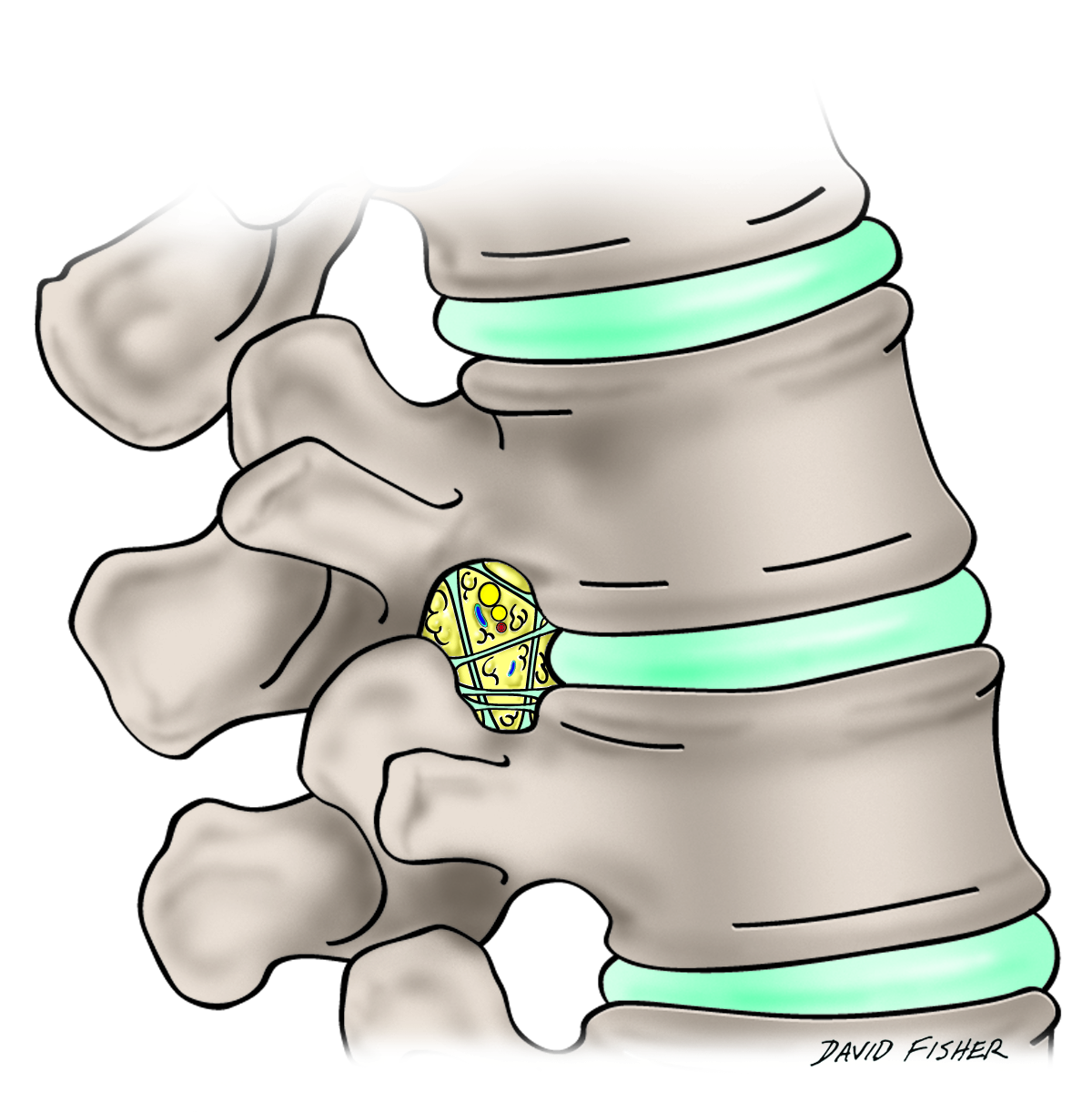 cureus-transforaminal-ligaments-of-the-lumbar-spine-a-comprehensive