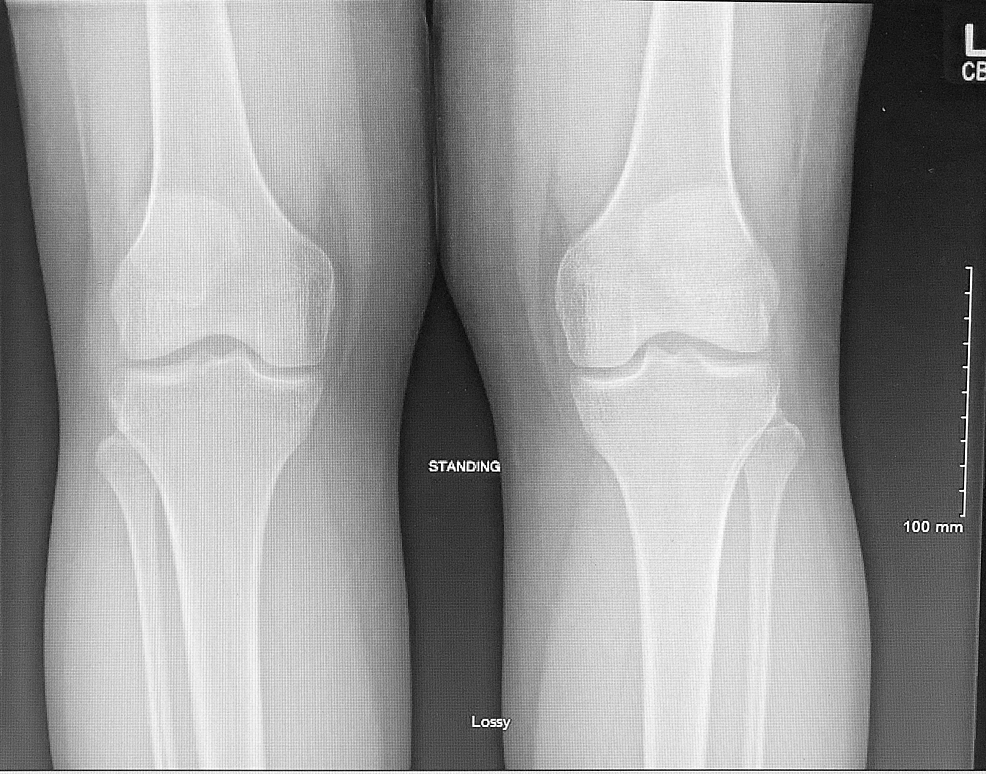 Migratory Polyarthritis In The Setting Of Chlamydial Infection 