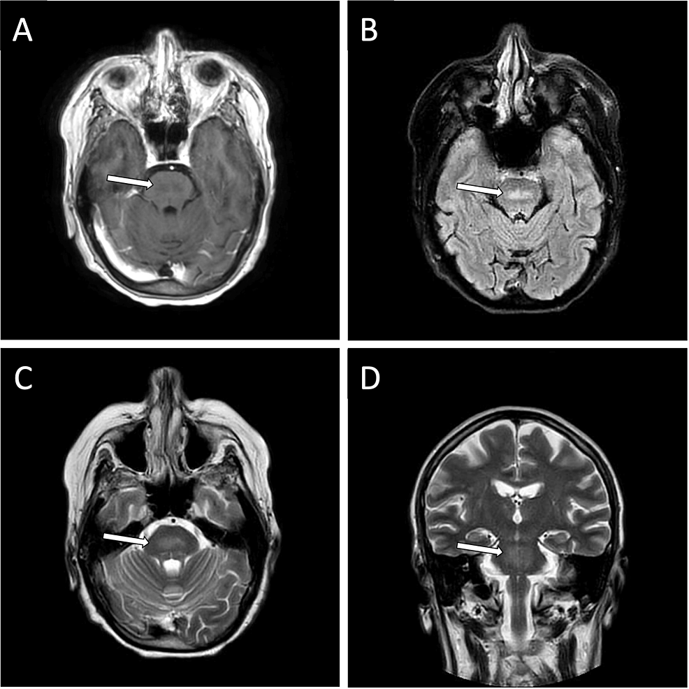 Osmotic Demyelination Syndrome in a Normonatremic Patient Under ...