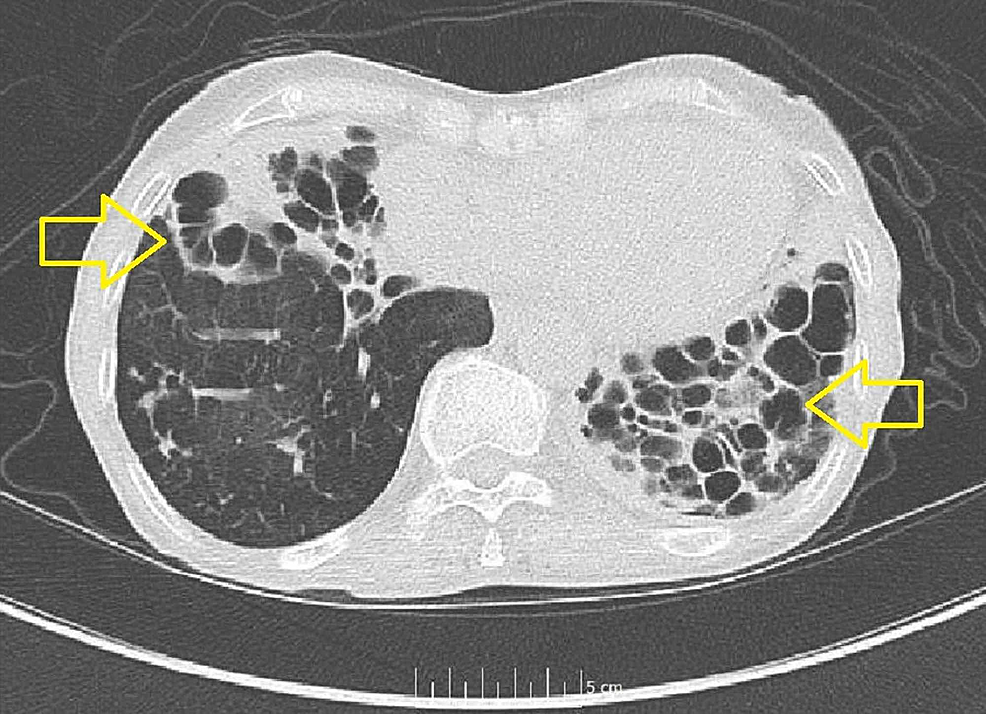 Repeat-CT-chest-without-contrast,-read-as-extensive-long-standing-cystic-bronchiectasis-and-fibrosis-with-overall-appearance-stable-and-unchanged-from-previous-imaging.