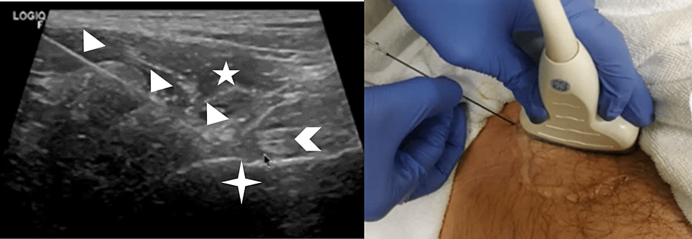 Ultrasound-Guided Radiofrequency Ablation for Chronic Hip Pain Due to ...