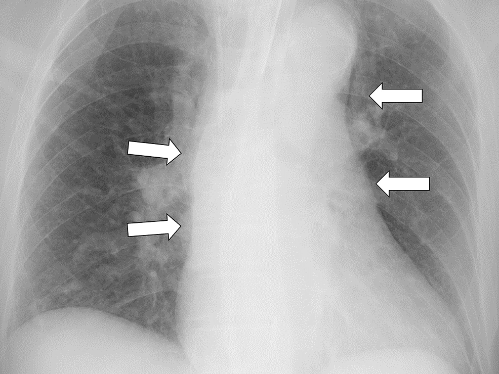 Aortic Dissection And Hypotension Without Cardiac Tamponade A Case 