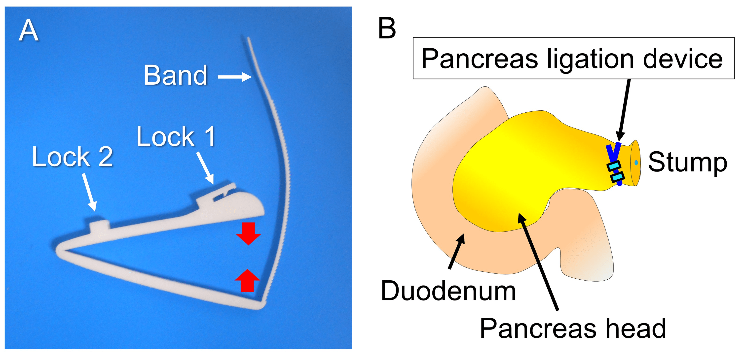 Pancreas Ligation Device for Distal Pancreatectomy An Ex Vivo Follow