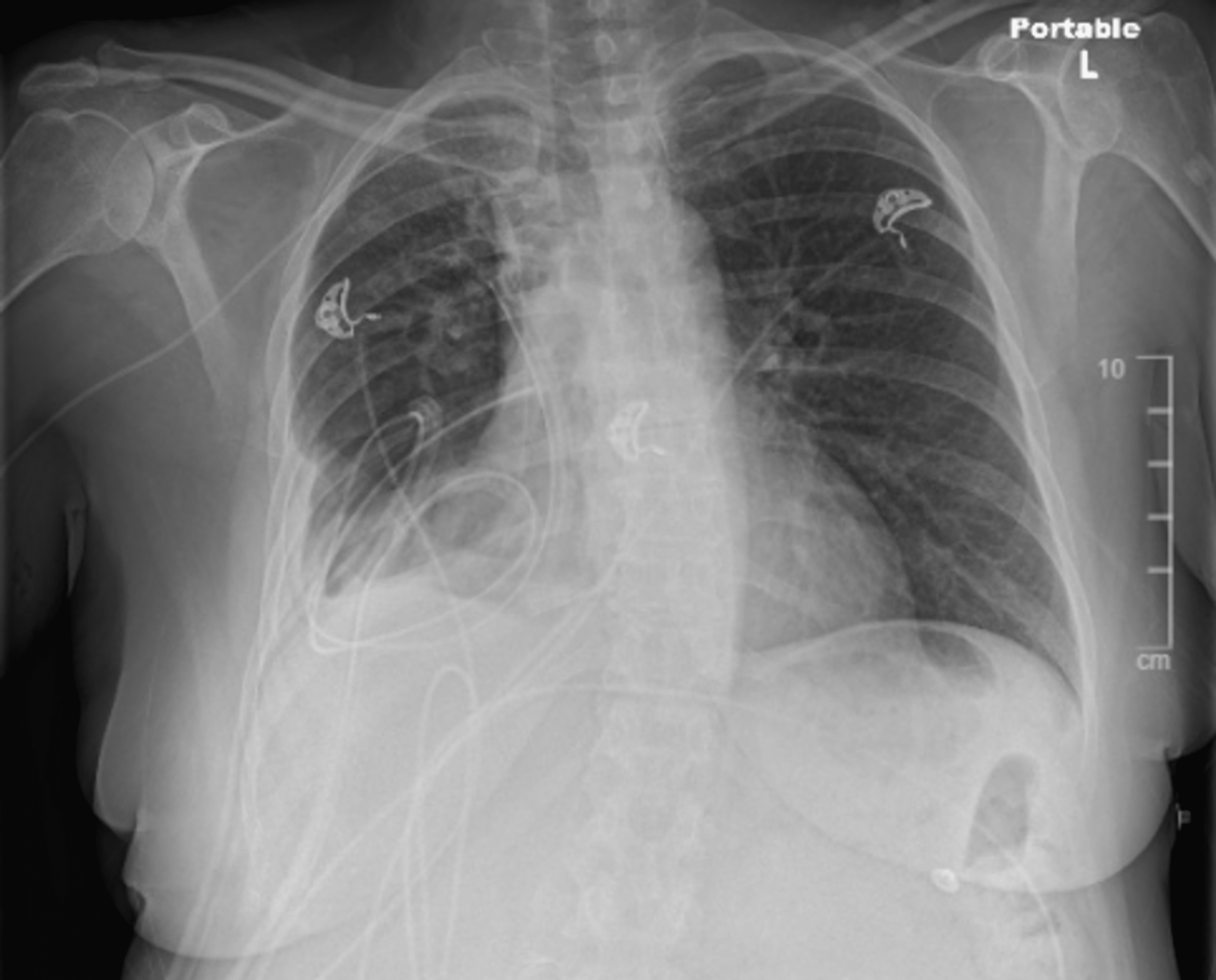 Cureus | veillonella intrapulmonary abscess with empyema