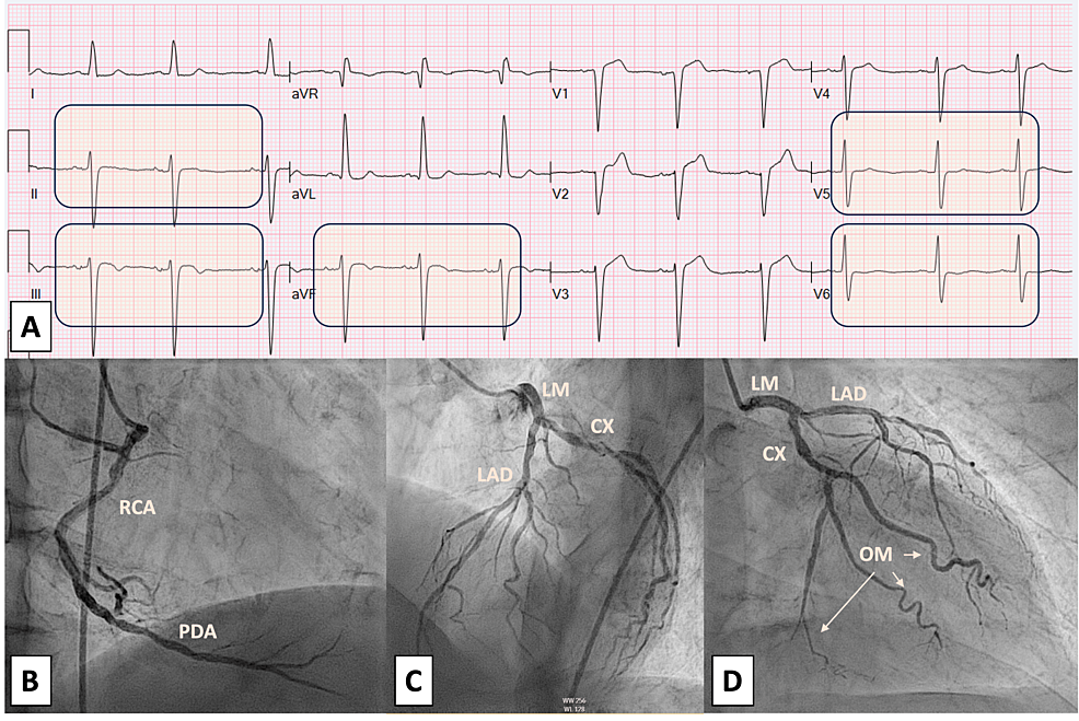 Allergy Induced Myocardial Infarction - Kounis Syndrome / Coronary  Hypersensitivity Disorder / Vasospastic Angina