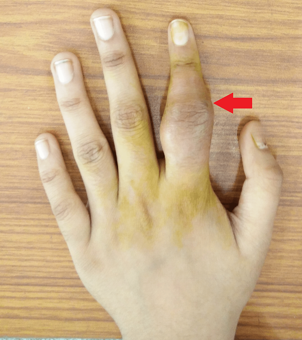 Cureus | Spina Ventosa of the Left Index Finger in an Indian Girl With No  Pulmonary Involvement: A Rare Case