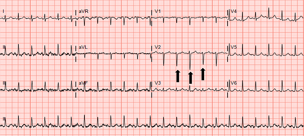 Cureus | Cardiac Tamponade in an 18-year-old Male with Undiagnosed ...