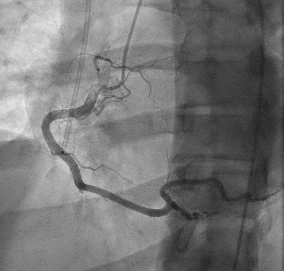 cardiac catheterization interpretation of findings