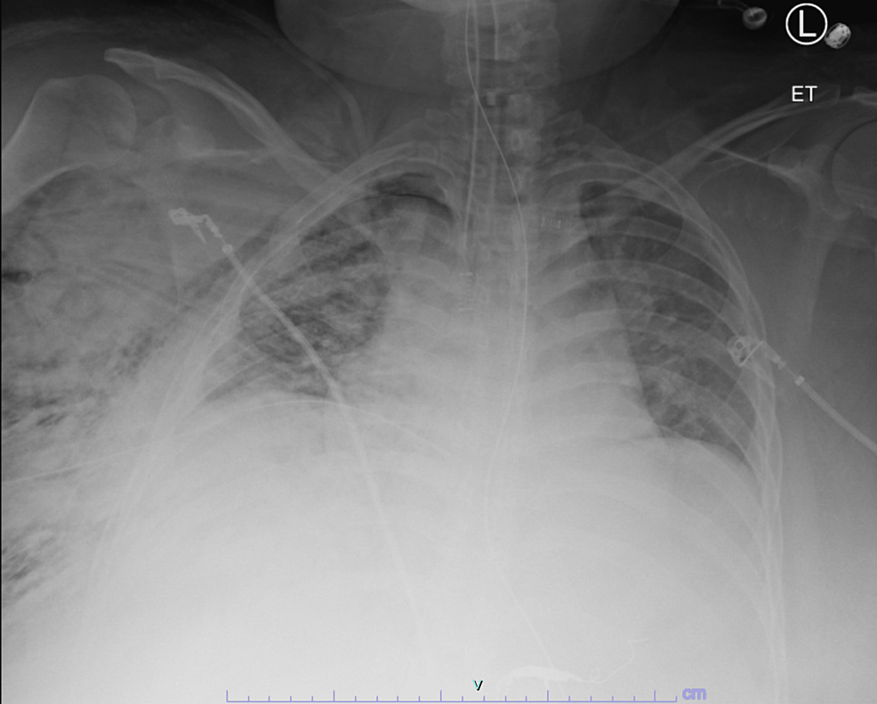 Cureus Progression and Resolution of a Posttraumatic Pleurocutaneous