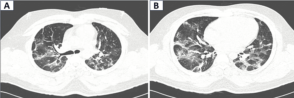 Cocaine-Induced Steroid Resistant Organising Pneumonia in a Young Male ...