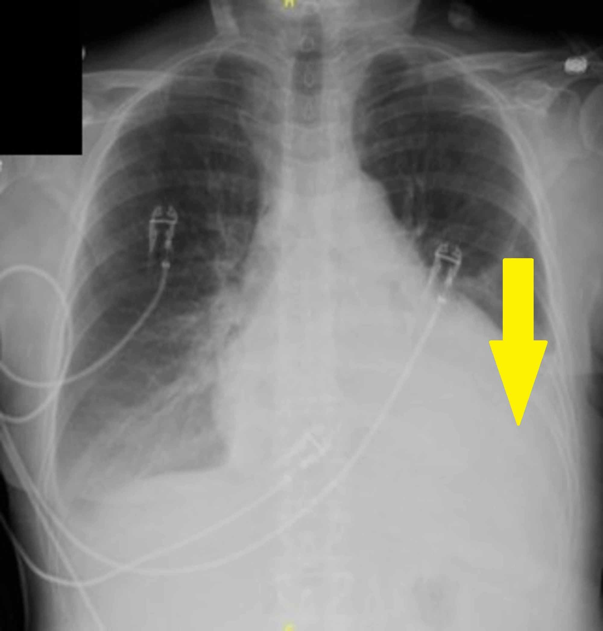 how-fast-does-small-cell-lung-cancer-spread-to-the-brain