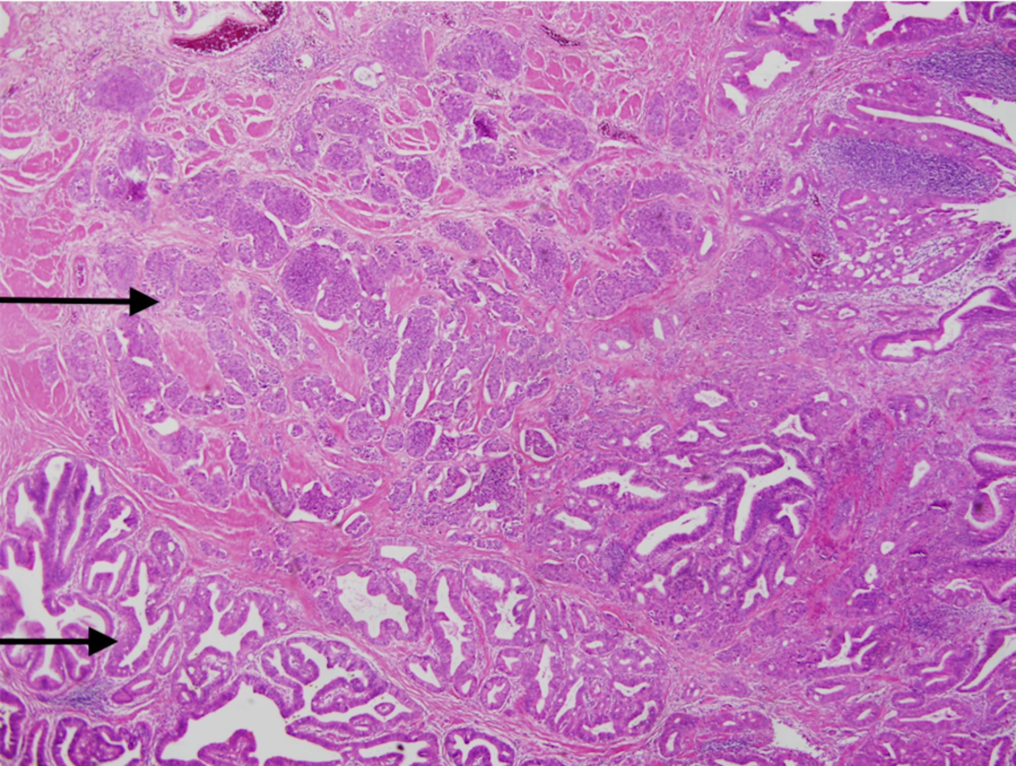 Cureus When Adenocarcinoma Went Hand In Hand With Neuroendocrine Tumor A Rare Case Of