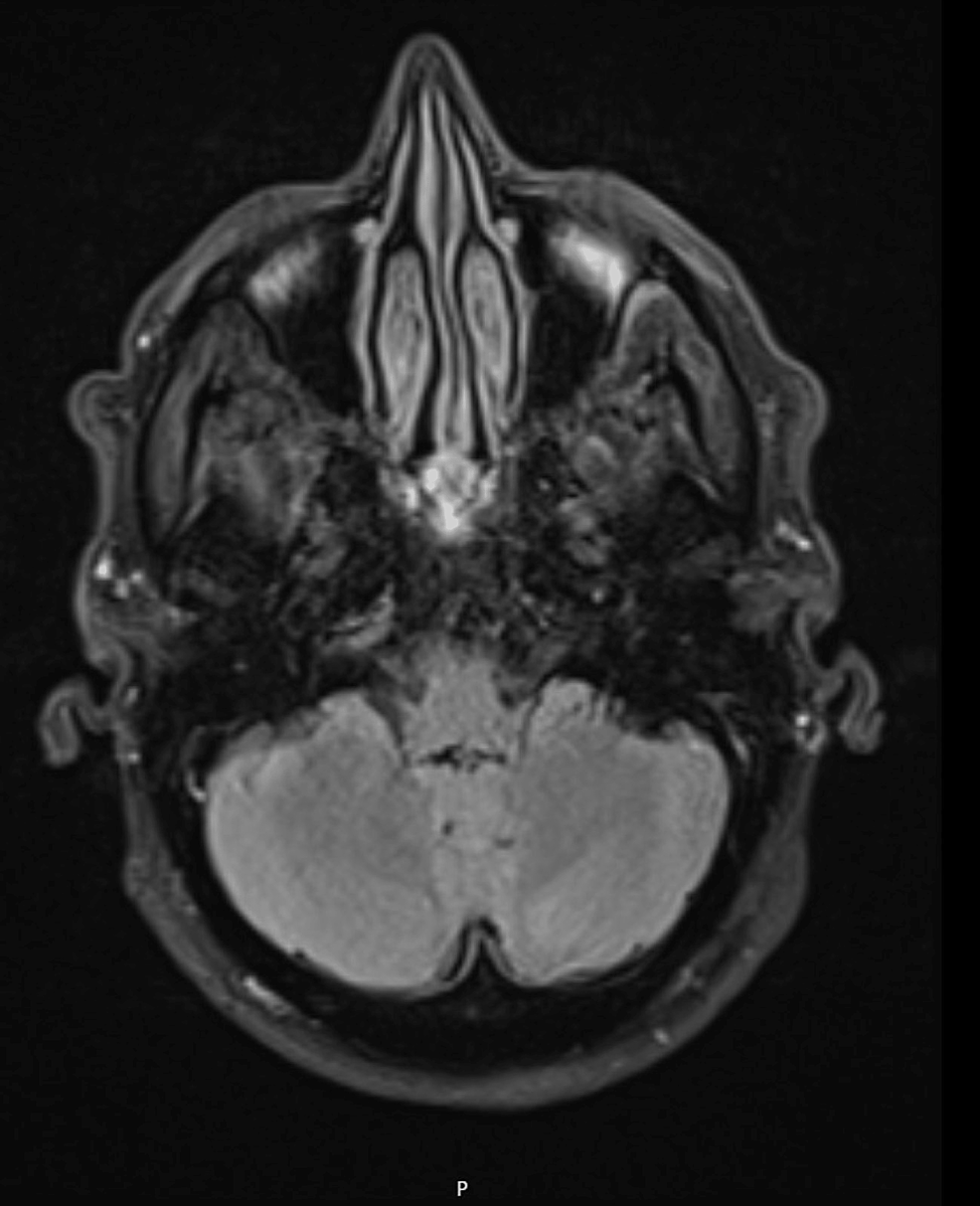 A Stroke Mimic With Postictal Todd’s Paresis and a Simplified Guide to ...