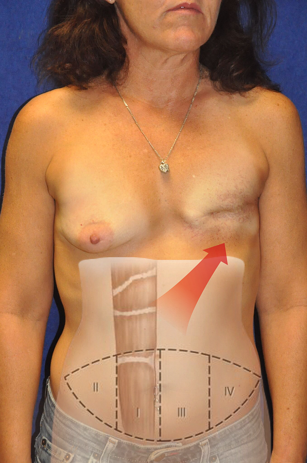 DIEP Flap Breast Reconstruction, Austin, TX
