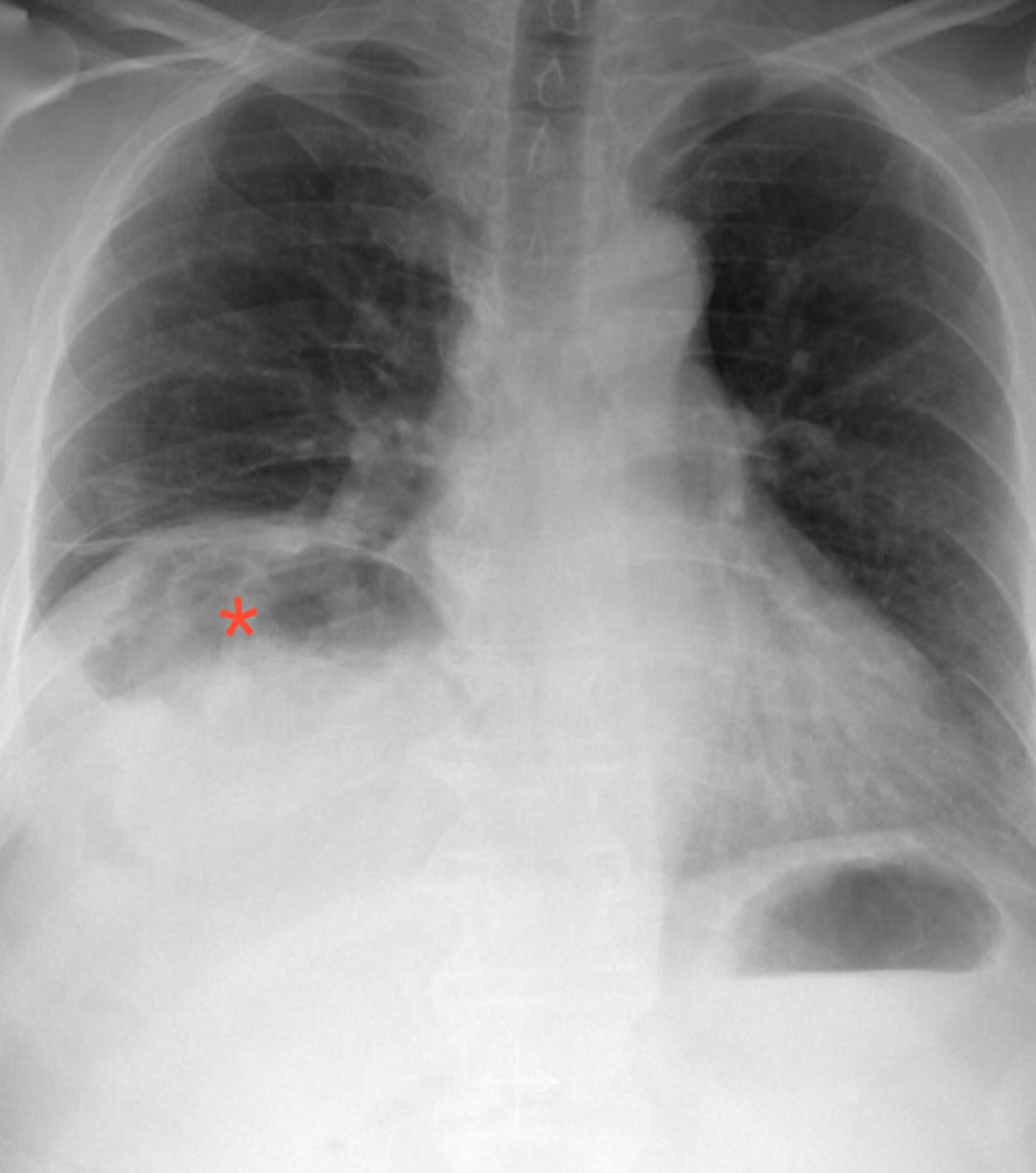 Cureus Gut Entrapped in the Thorax A Rare Presentation of Abdominal