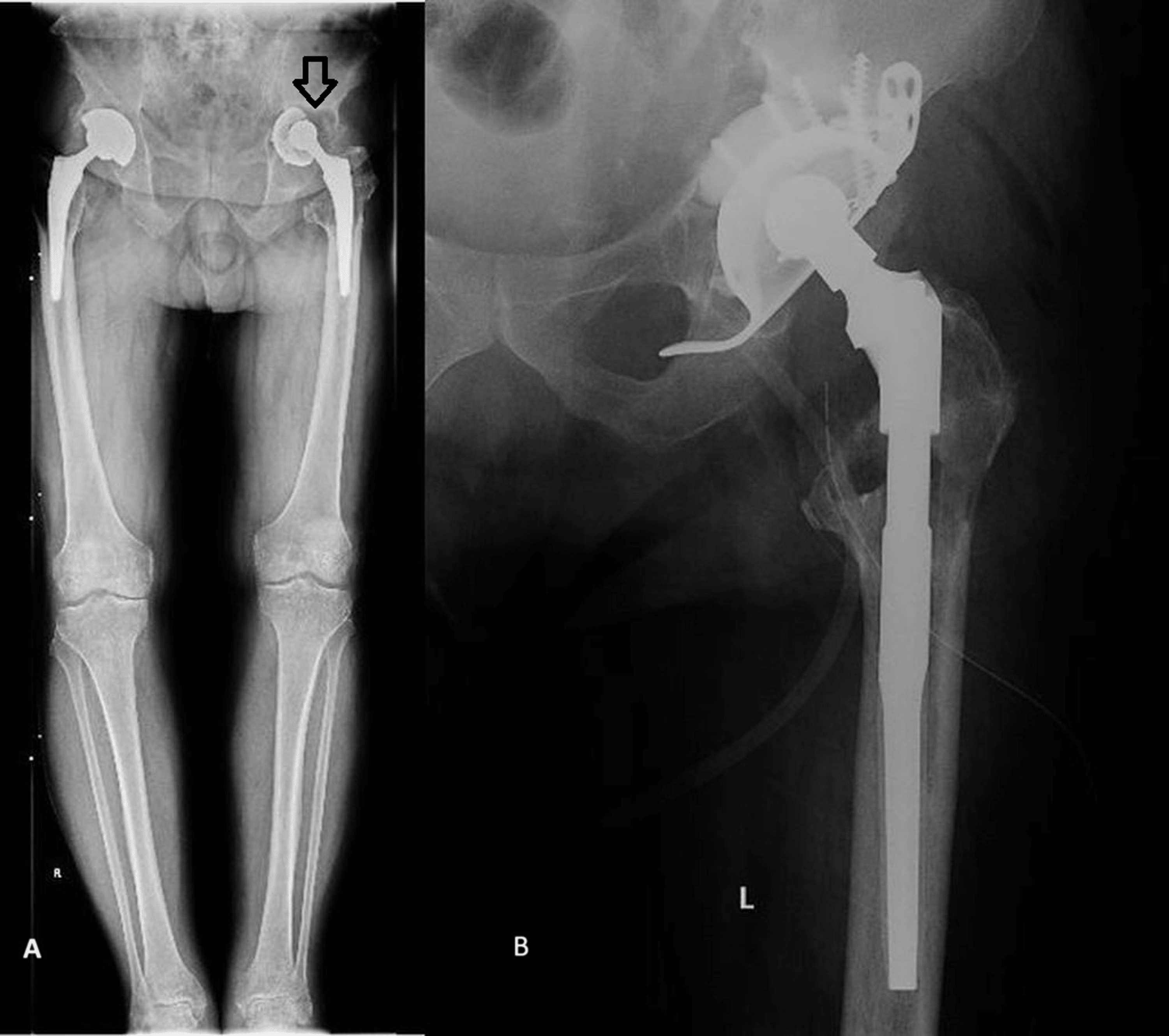 Management of Acetabular Bone Loss in Hip Revision Arthroplasty Case Series Presentation Cureus