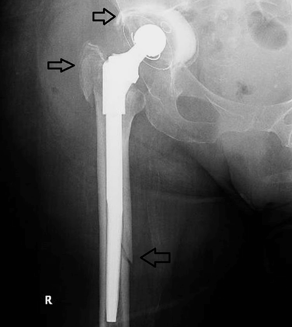 Cureus Management of Acetabular Bone Loss in Hip Revision