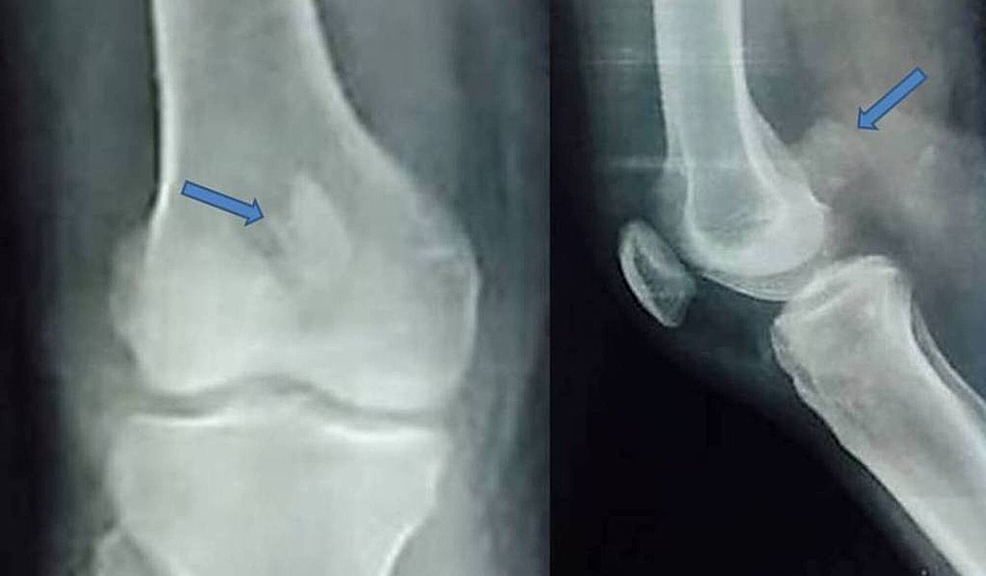 Medial Femoral Condyle Fracture