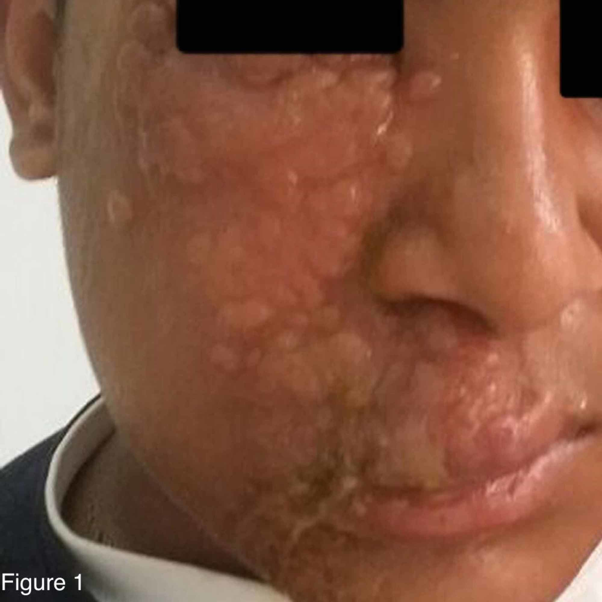Cureus Herpes Zoster Eruption In An Otherwise Healthy Child A