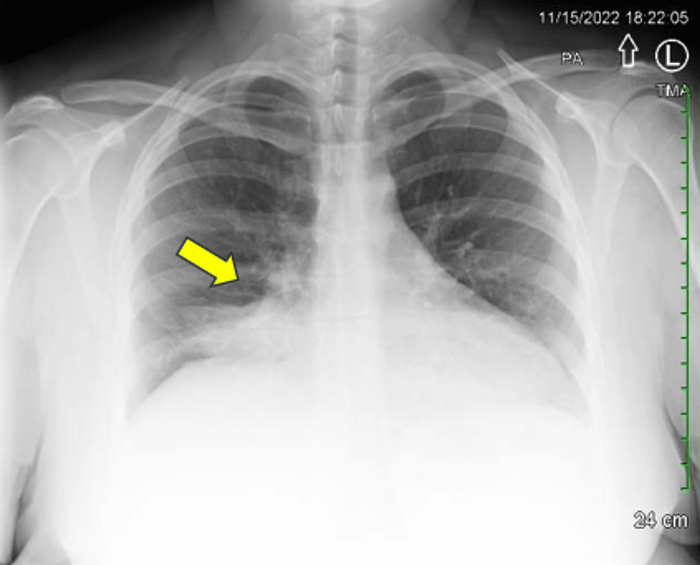 Masquerading as Pneumonia A Lung Neuroendocrine Tumor Case Report Cureus