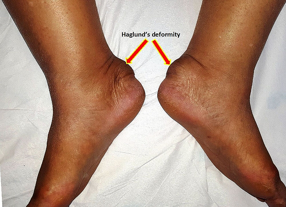 Haglunds Deformity | Heel Pain Treatment | Melbourne Podiatrist