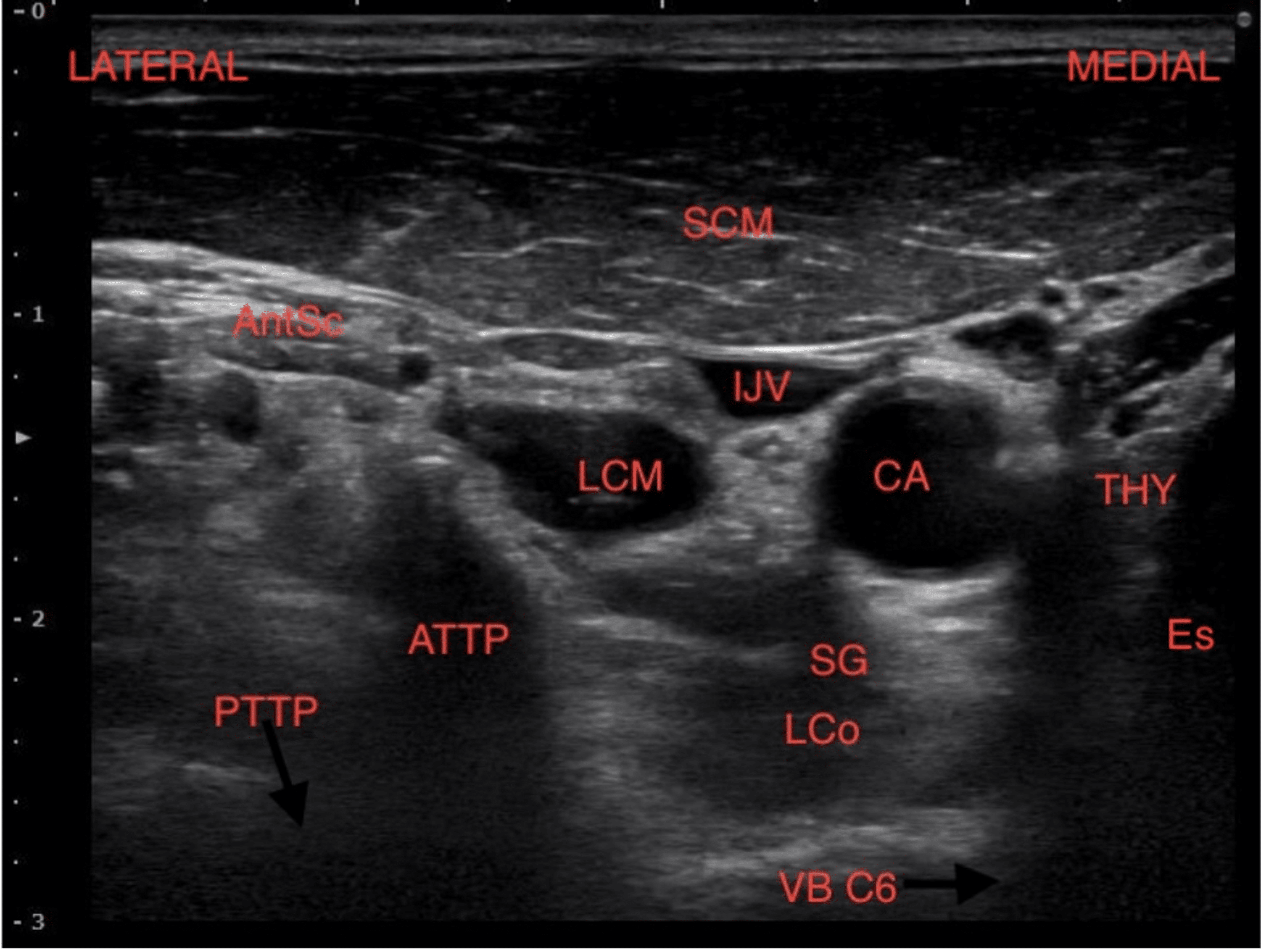 Cureus Stellate Ganglion Block Relieves Long COVID19 Symptoms in 86