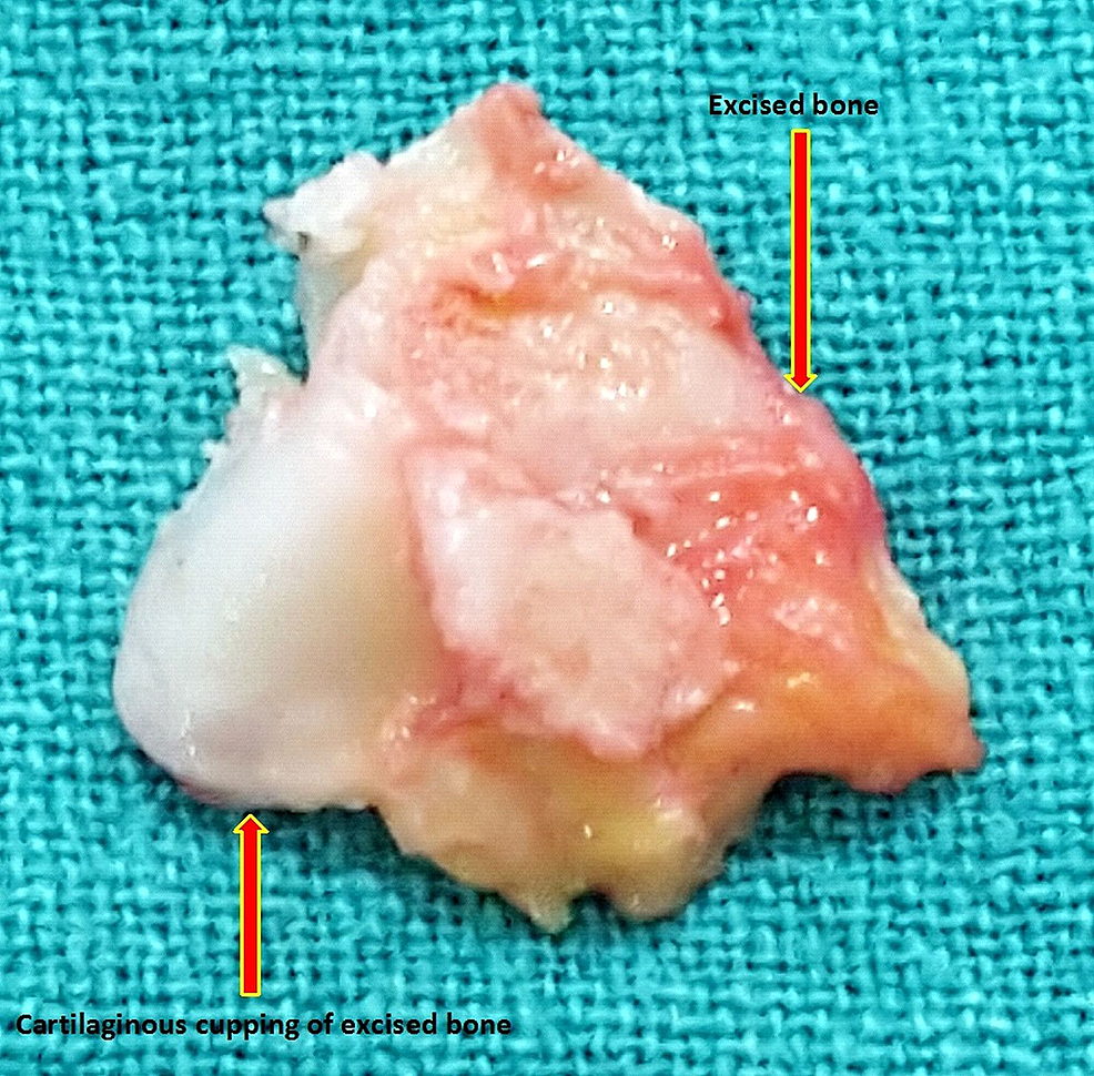 Cureus | Haglund’s Syndrome: A Commonly Seen Mysterious Condition