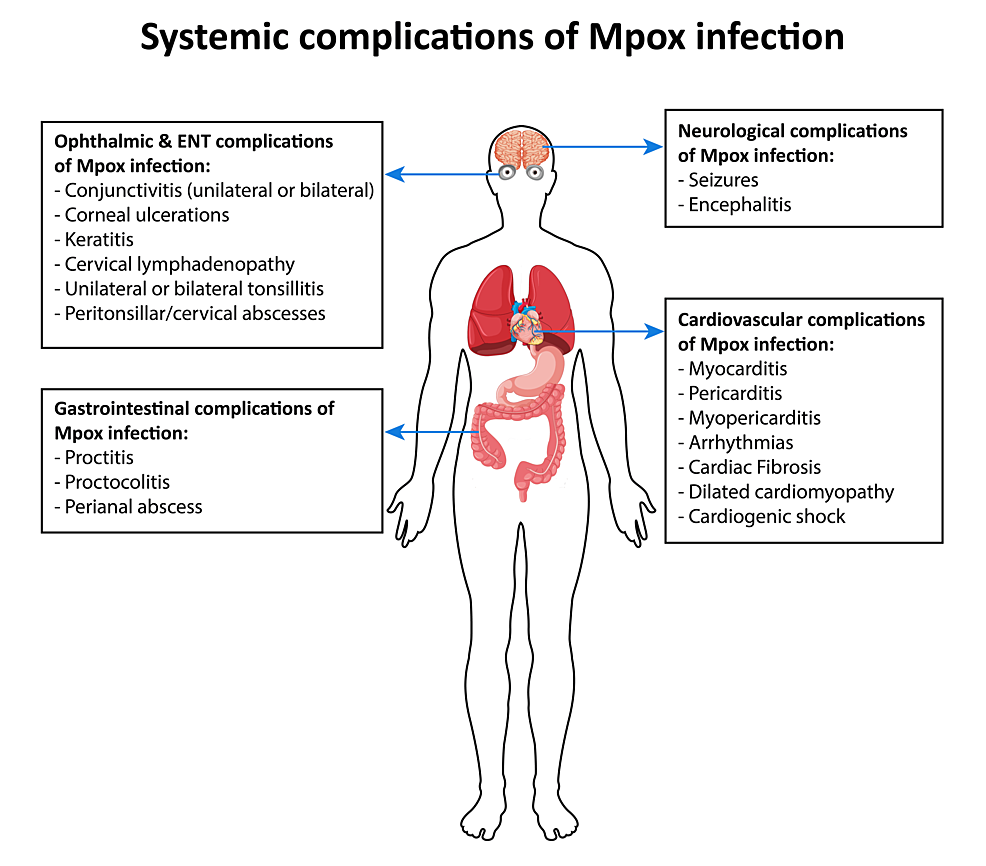 Mpox (Monkeypox): Signs, Symptoms, and Complications