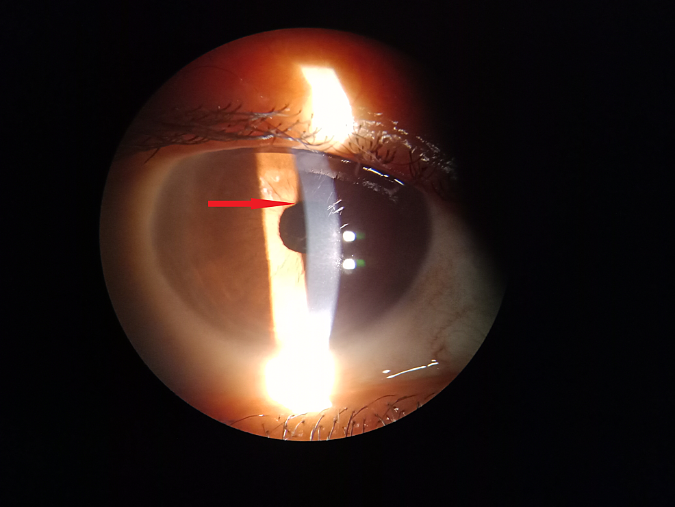 Cureus Penicillium on the Iris! An Unusual Presentation and Cause of