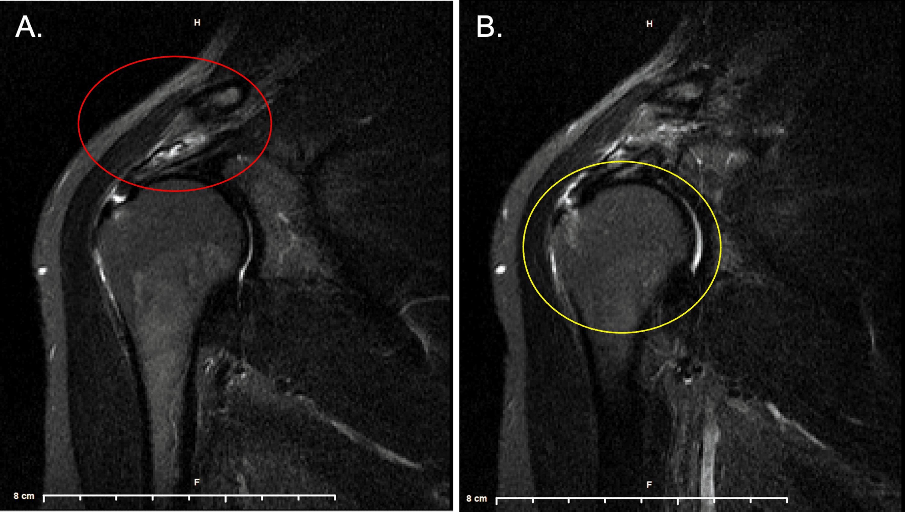 Osteopathic Manipulative Treatment for a Chronic Rotator Cuff Tear A