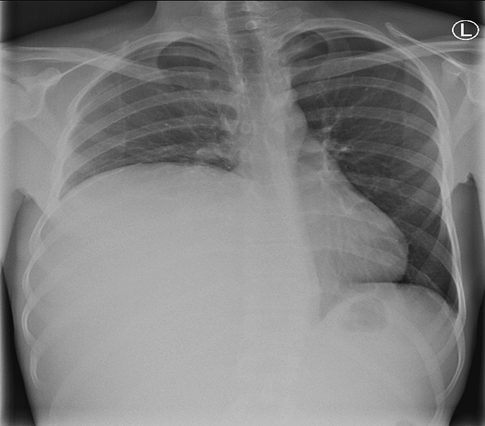 Cureus Giant Hydatid Cyst of the Liver Presenting With Severe Chest