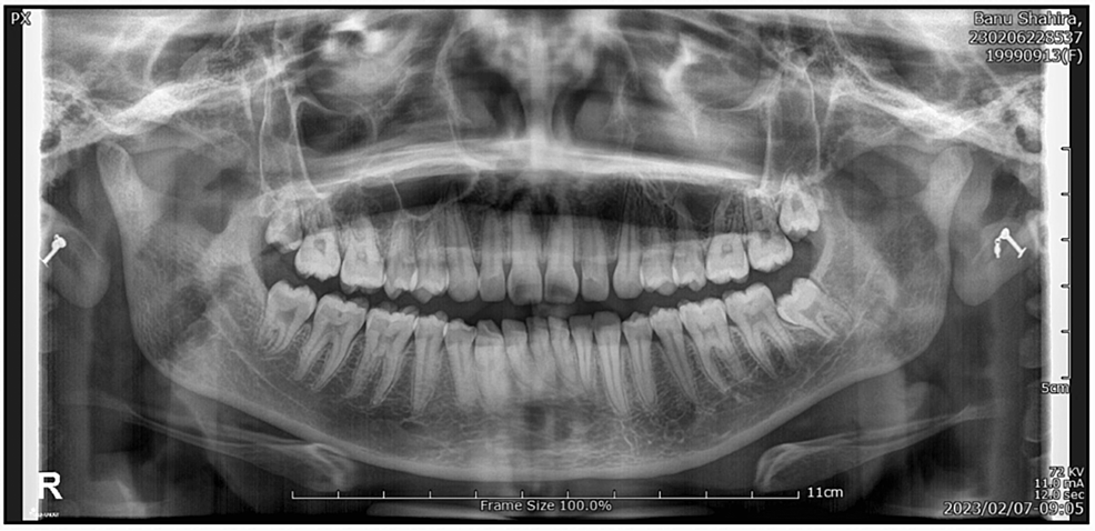 Digital Panoramic Radiographs for Age Prediction Utilizing the Tooth ...