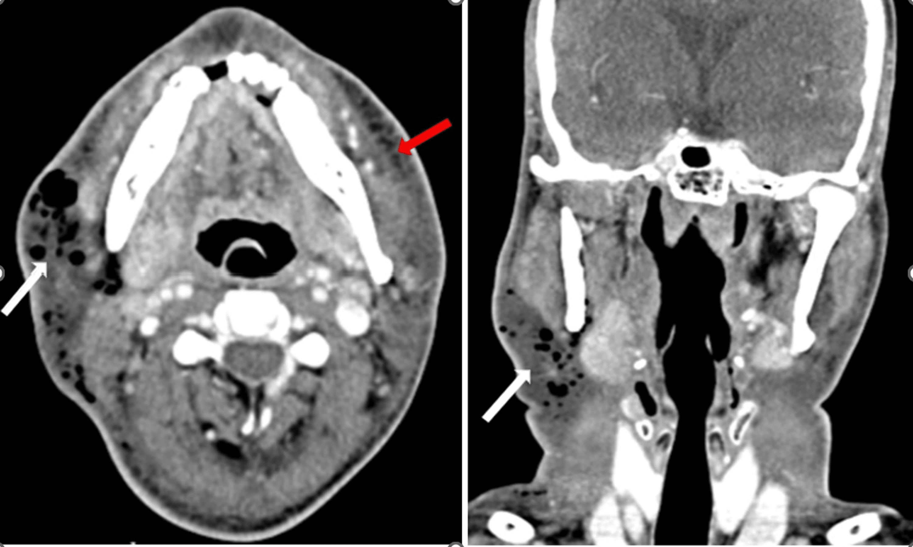 Cervical Necrotizing Fasciitis A Surgical Analysis Cureus