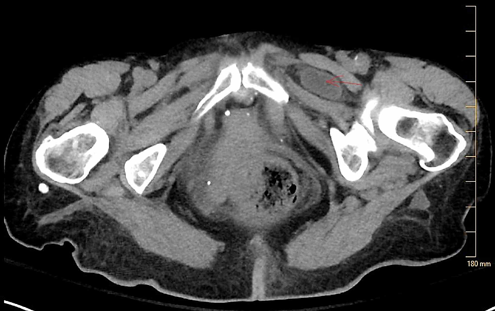 Cureus Asynchronous Bilateral Obturator Hernias A Suggested Approach to Reduce Morbidity of Cureus Asynchronous Bilateral Obturator Hernias A Suggested Approach to Reduce Morbidity of