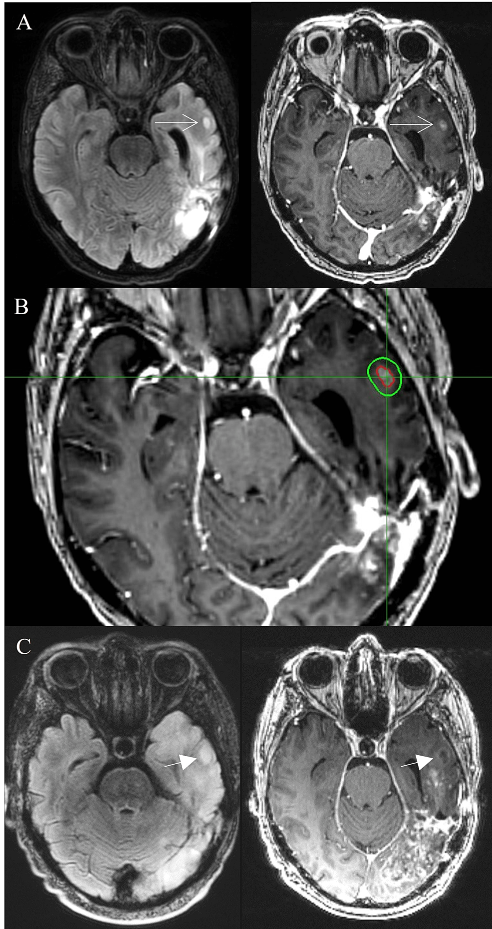 Cureus Stereotactic Radiosurgery for ContrastEnhancing Satellite