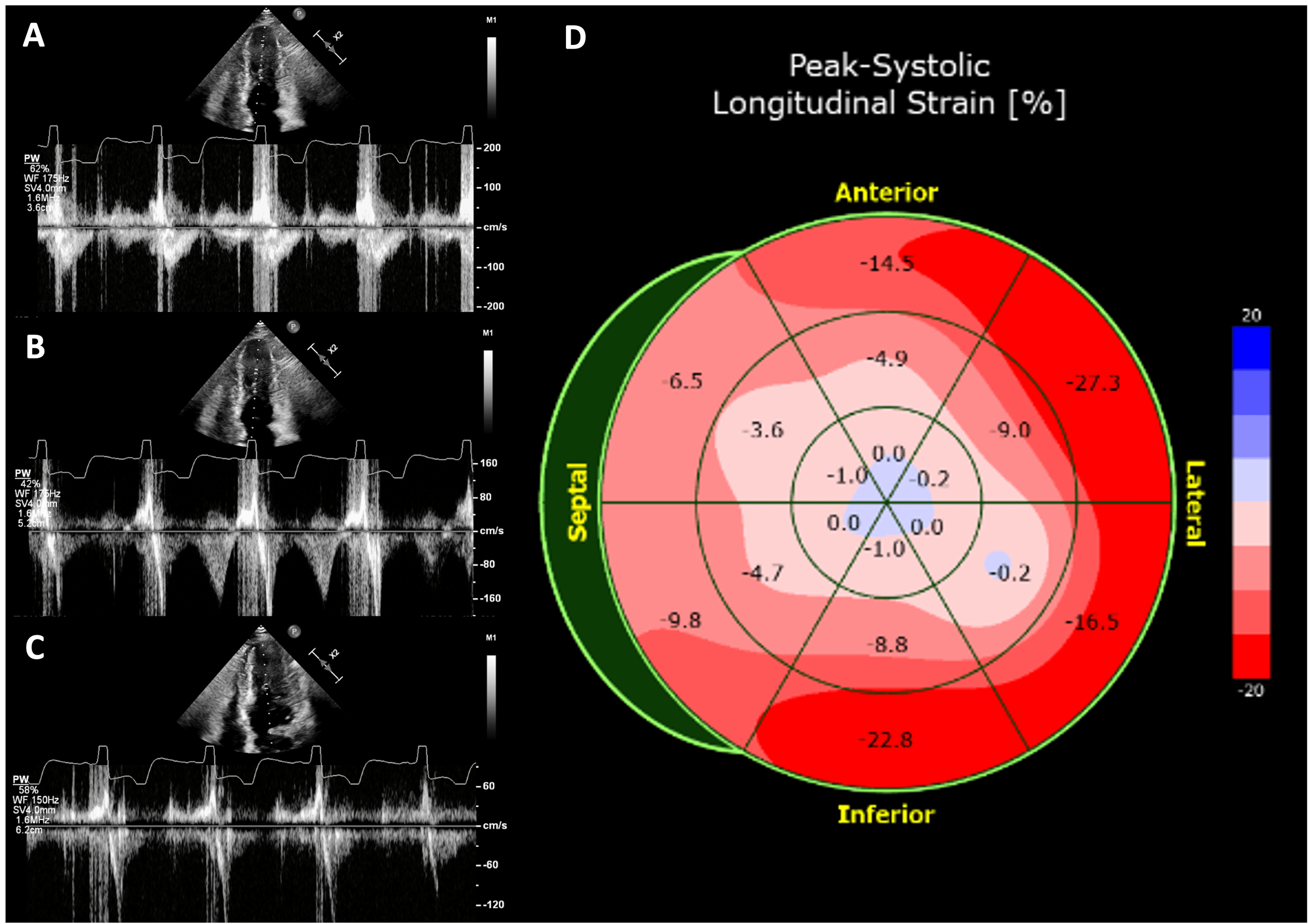 Cureus | An Unusual Presentation of Apical Hypertrophic Cardiomyopathy ...