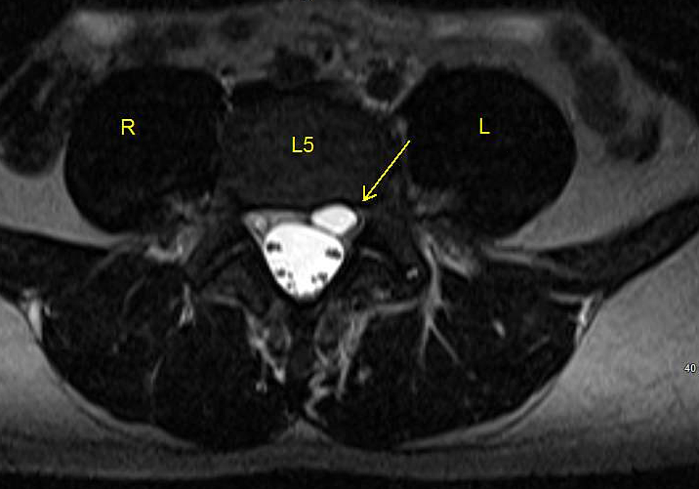 Axial Mri Lumbar Spine My Xxx Hot Girl