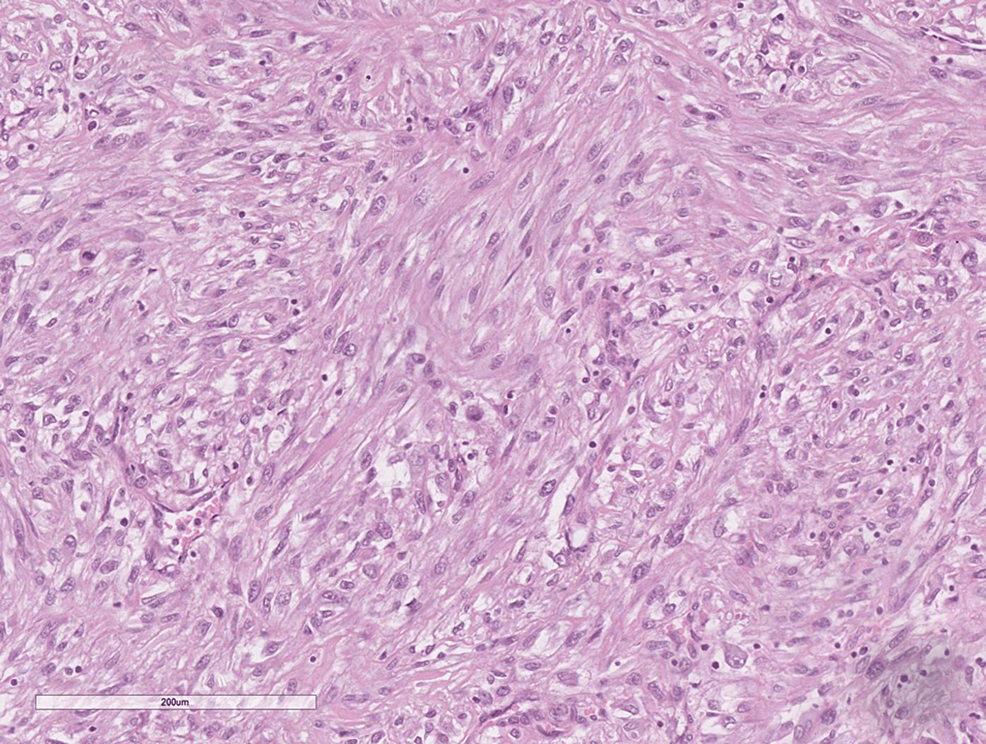 Cureus Spindle Cell Renal Neoplasms A Pathological Case Report on