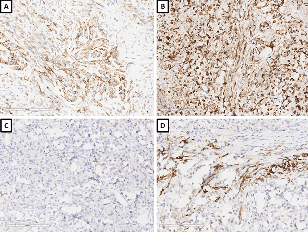 Cureus Spindle Cell Renal Neoplasms A Pathological Case Report on