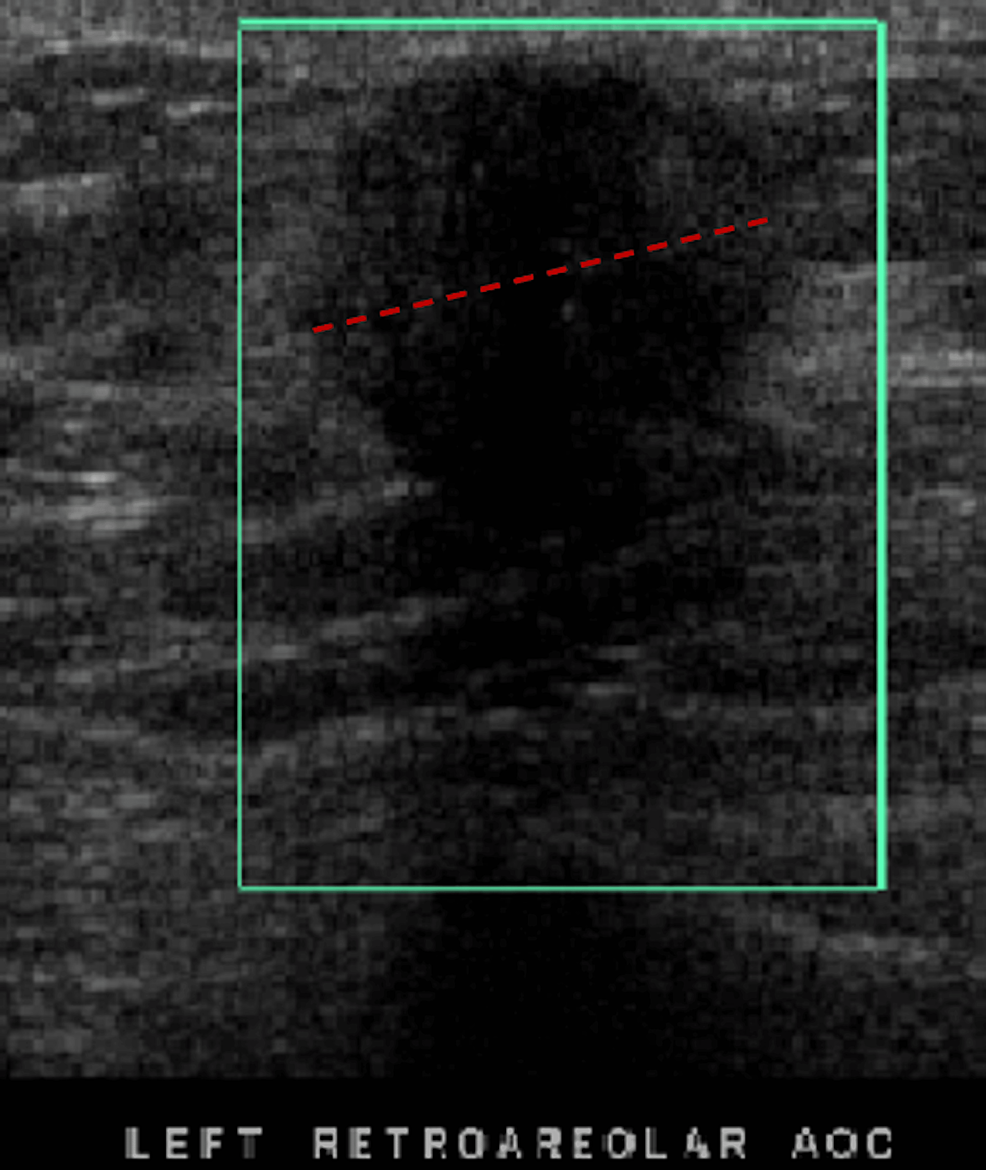 A Rare Case of Remittent Male Invasive Ductal Carcinoma With New ...