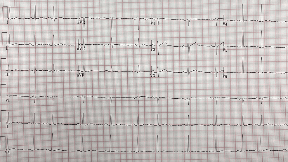 A Stroke of Bad Luck An Autobiographical Case Report Cureus