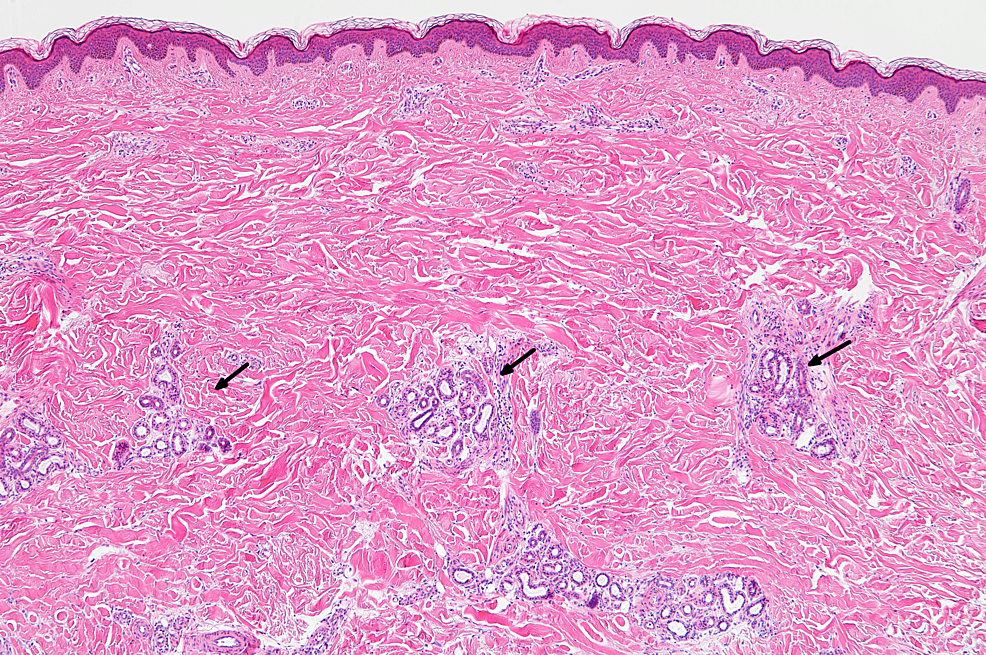 Successful Rituximab Therapy for Skin Sclerosis and Myositis in a ...