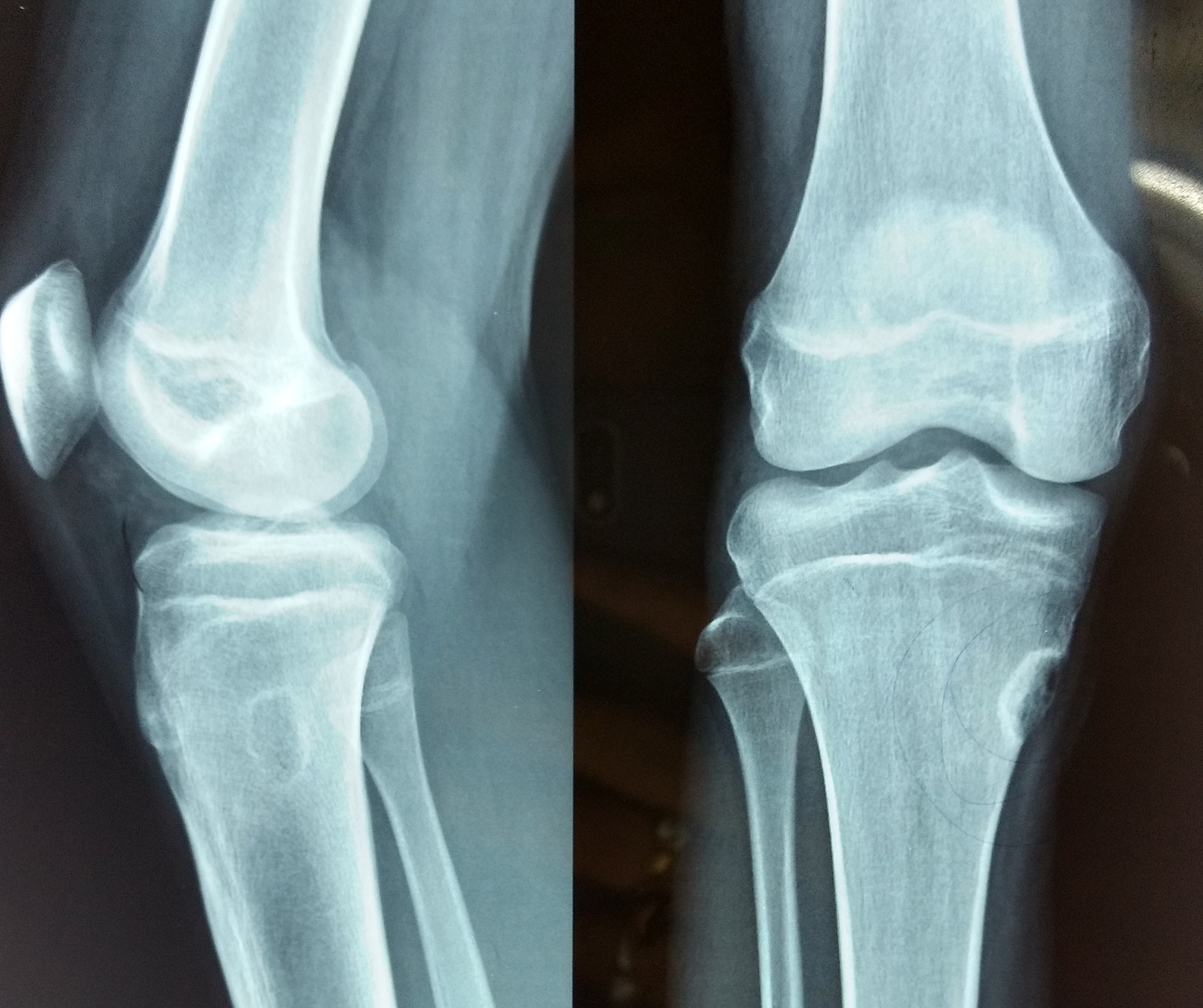 Cureus | Chondromyxoid Fibroma: A Rare Case Report and Review of Literature