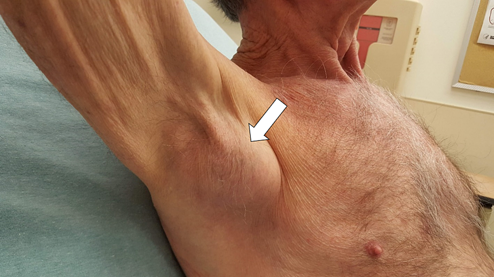 swollen armpit lymph nodes