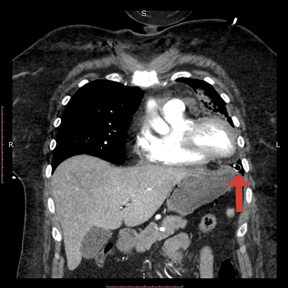 Stress Cardiomyopathy Following Thoracostomy Tube Placement And 