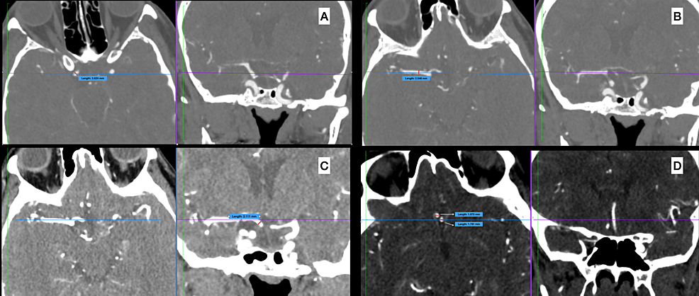 Cureus, Brainstem and Spinal Arachnoiditis Ossificans Associated With  Neurocysticercosis: A Case Report