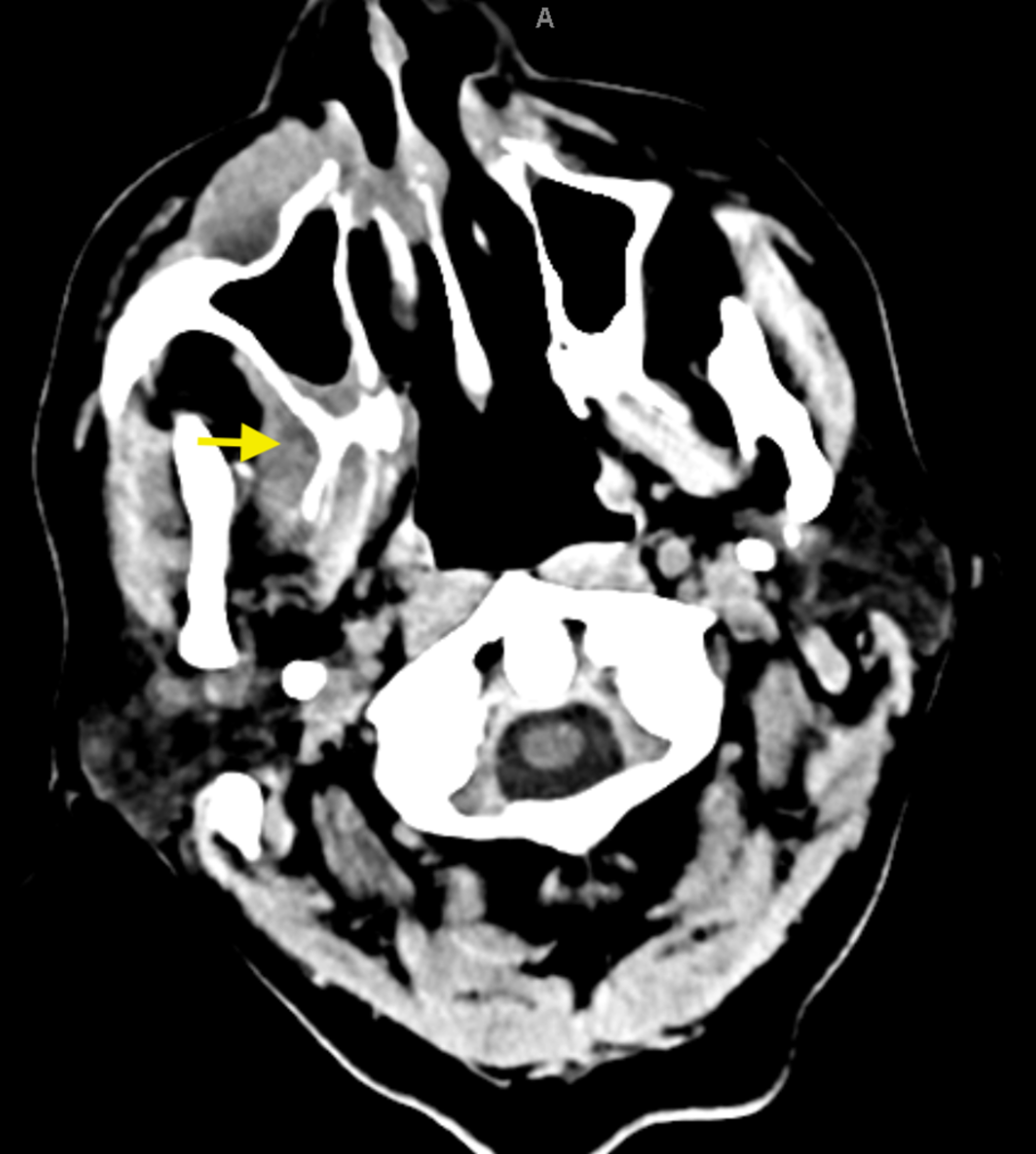 Cureus Maxillary Osteomyelitis with an Incidental Diagnosis of